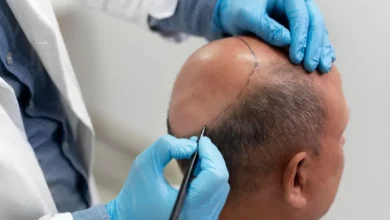 Hair Transplant in Dubai