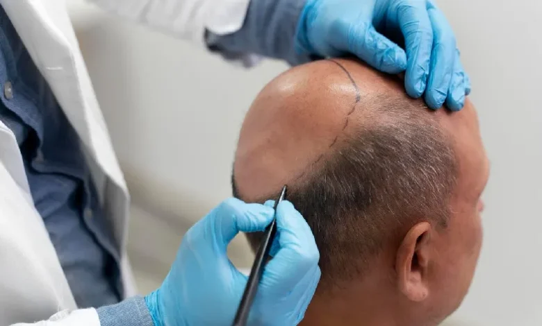Hair Transplant in Dubai